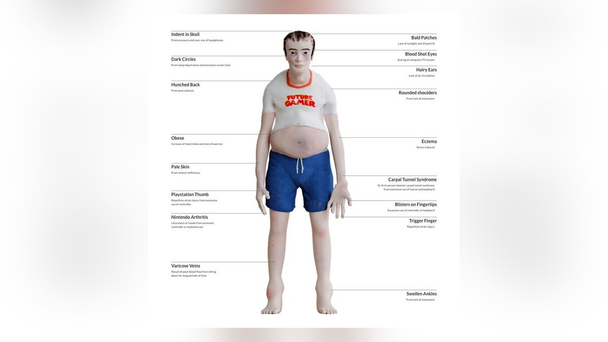 Горб и волосатые уши — в сети показали, как может выглядеть геймер, если  будет много играть