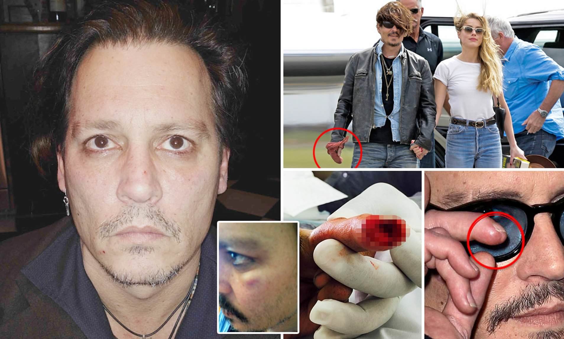 Does johnny depp have keratoconus